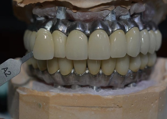 Korrosionsbeständiges Co-Cr-Implantat gestütztes Metallkronen-biologisches Material